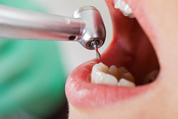 Best Emergency Dentist for Lost Fillings or Crowns in Monrovia, CA